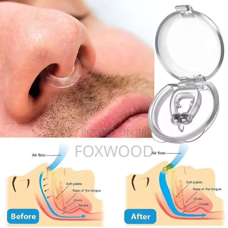 *Anti-Snoring Device