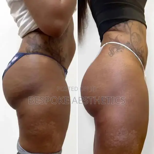 Instant Butt Increase, Lifting, and Filling