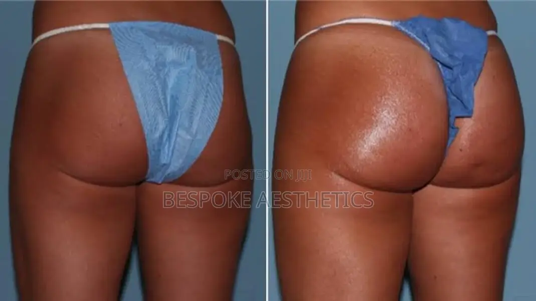 Instant Butt Increase, Lifting, and Filling