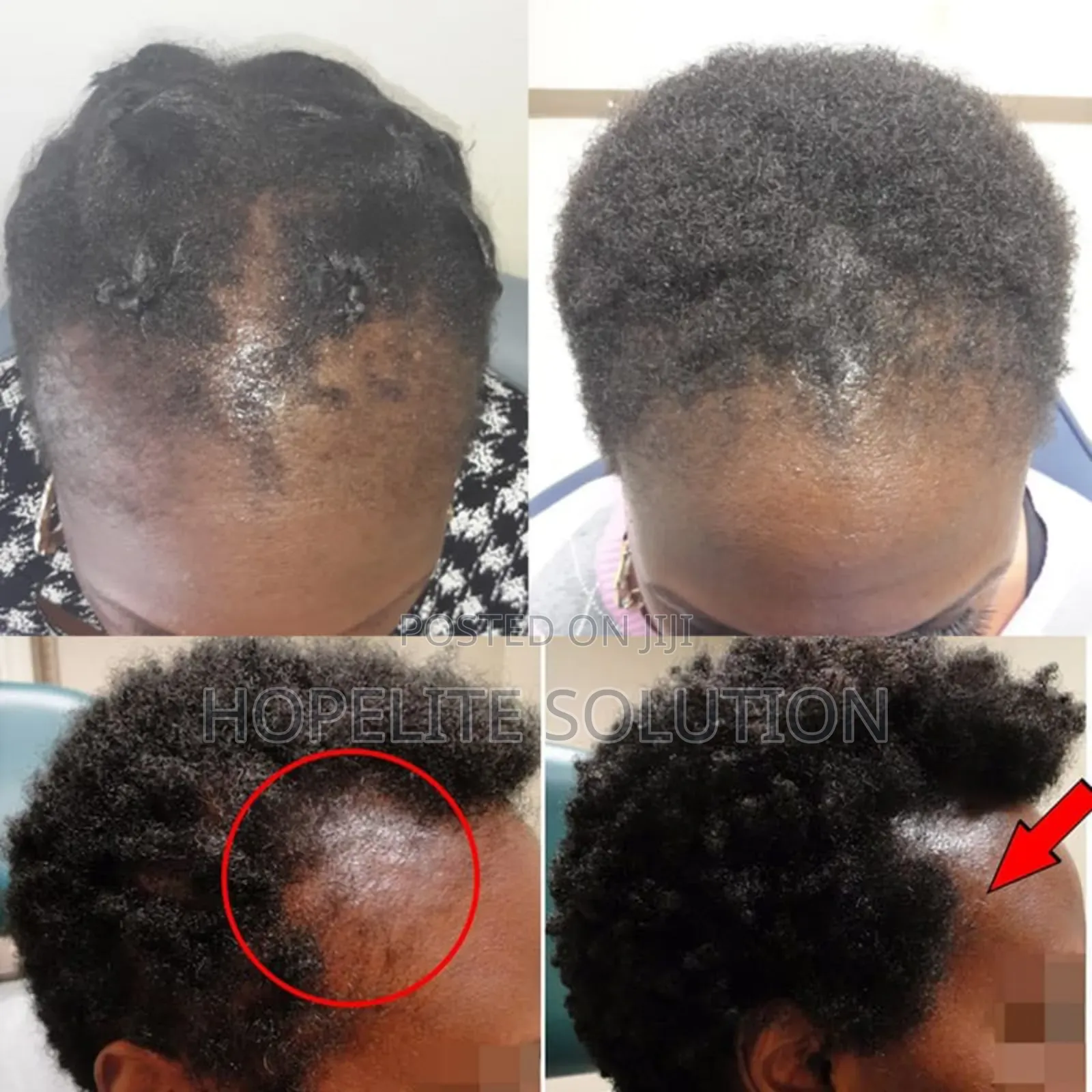Hair Growth Spray,Ant Hair Loss