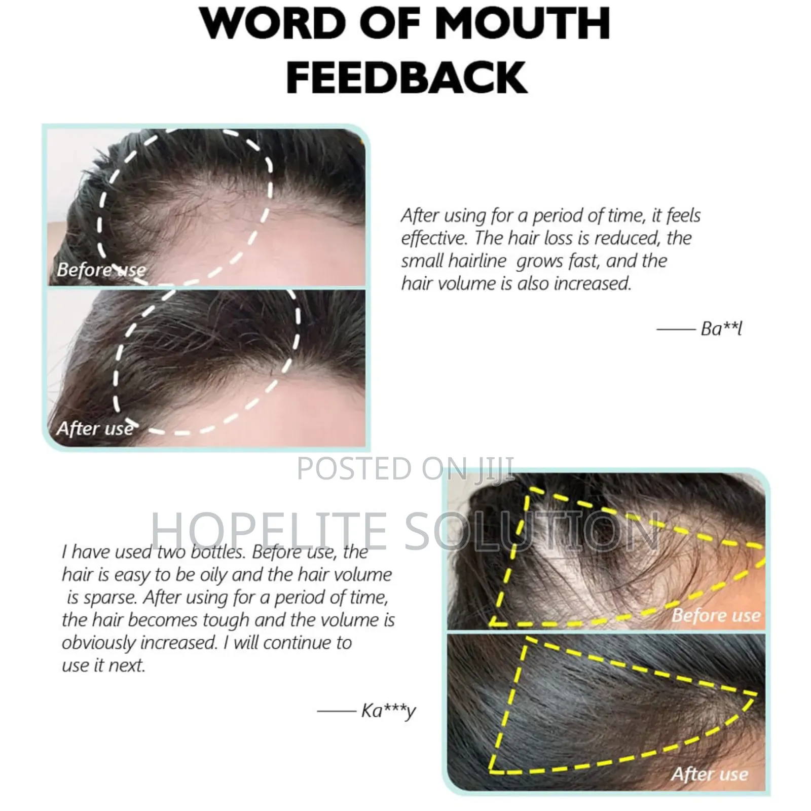 Hair Growth Spray,Ant Hair Loss