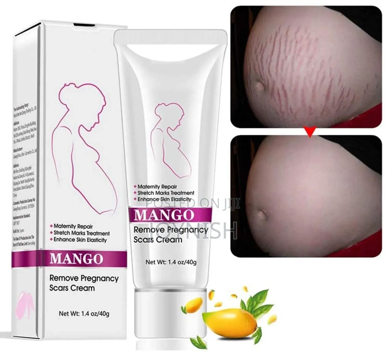 New Stretch Mark Cream Removes Stretch Marks Easily