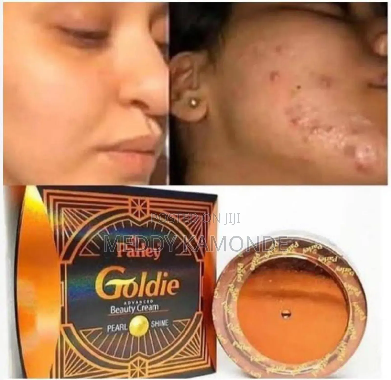Pimple Remover Soaps/Acne Soaps