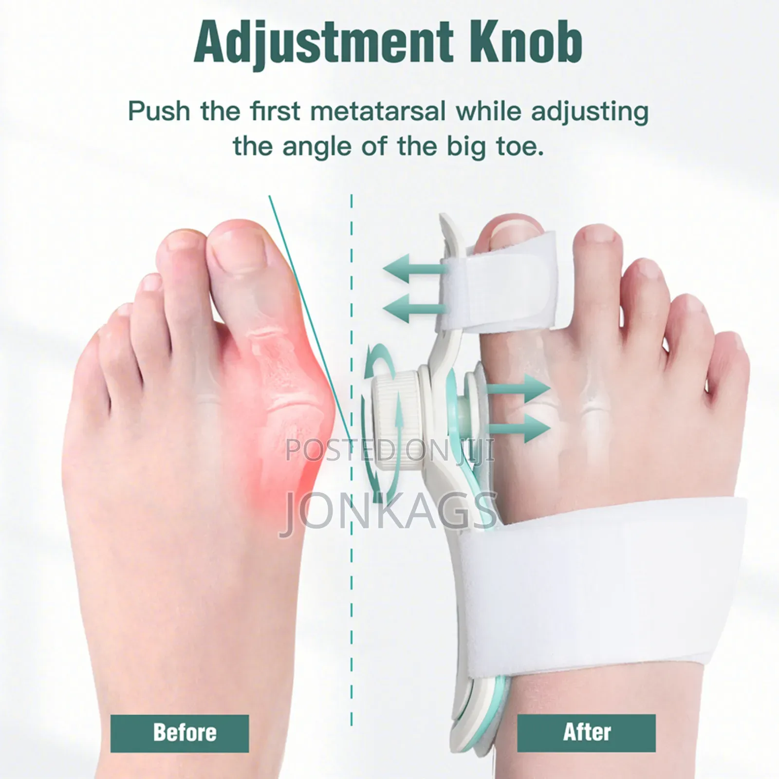 Adjustable Bunion Corrector