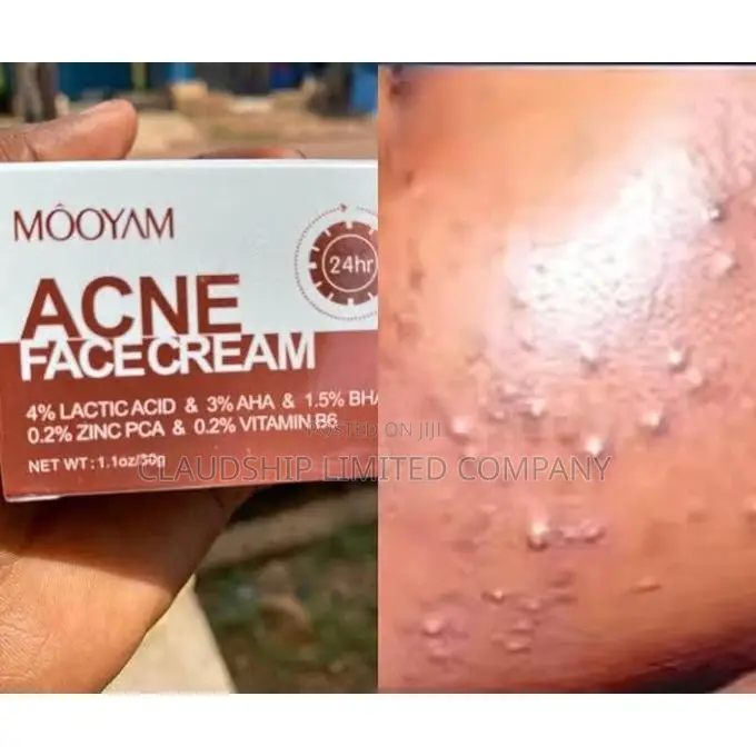 Acne Removal Face Cream
