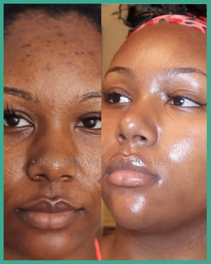 Acne Treatment That Removes Facial Blemishes