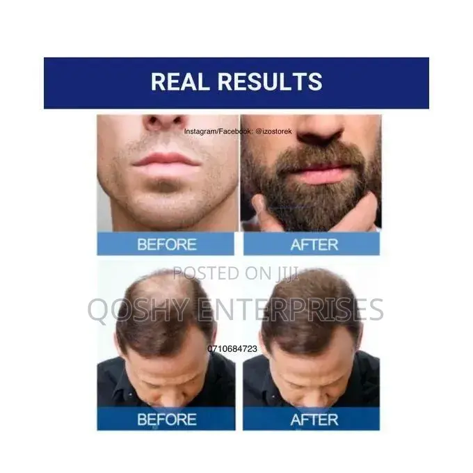 Kirkland Minoxidil 5% Hair Regrowth Treatment - 6 Bottles X 60ml